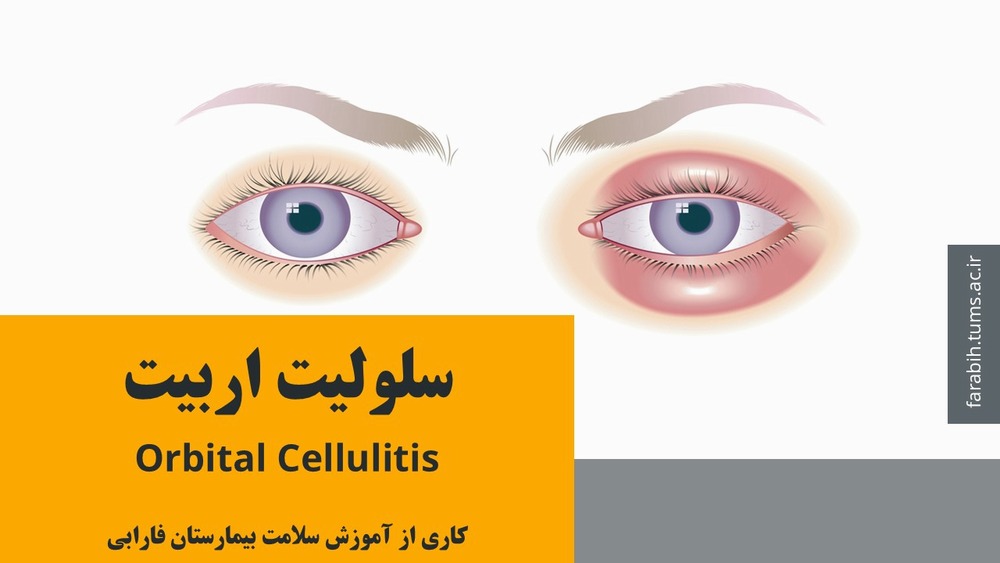 سلولیت اربیت و راه های درمان آن